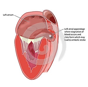 Heart left atrial appendage