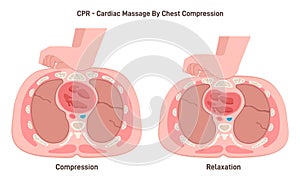 Heart massage or first aid cardiopulmonary resuscitation, chest compression