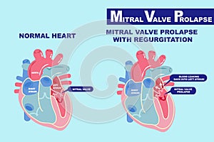 Heart with mitral valve prolapse photo