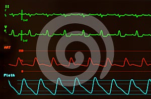 Heart Monitor with Intraventricular Conduction Delay on EKG