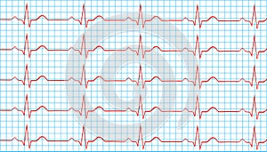 Heart Normal Sinus Rhythm On Electrocardiogram