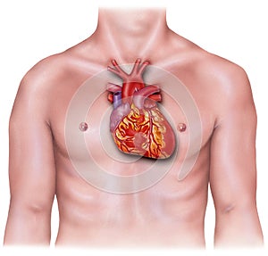 Heart - Overlaid on Male Torso, Inflamed