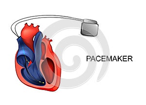 Heart and pacemaker. cardiology