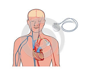 Heart pacemaker in work. Human heart artificial cardiac, ICD photo