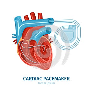 Heart Pacemaker Illustration photo