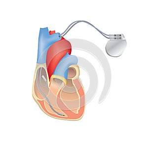 Heart pacemaker in work. Human heart anatomy with ICD