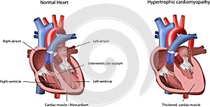 Heart Problem Hypertrophic Cardiomyopathy