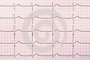 Heart rhythm chart