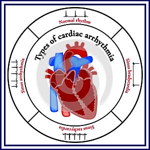 Heart structure. Types of cardiac arrhythmia. photo