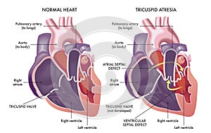 Heart with tricuspid atresia