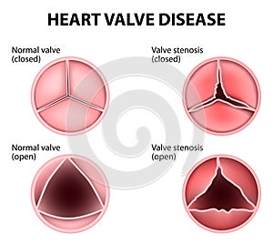 Heart valve disease