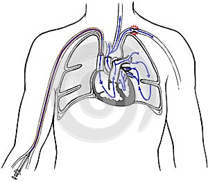 Heart - Venacava Dye Injection