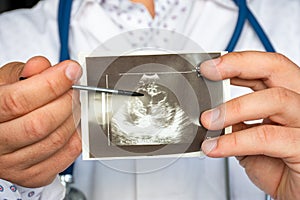 Heart ventricular dilation on ultrasound image concept photo. Doctor indicating by pointer on printed picture of ultrasound pathol