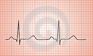 Heartbeat Normal ECG graph