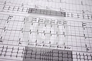 Heartbeat represented on paper. Cardiac arrhythmias. Selective focus on some beats. Supra ventricular tachycardia. Free space to