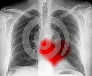Heartbeat on x-ray photo