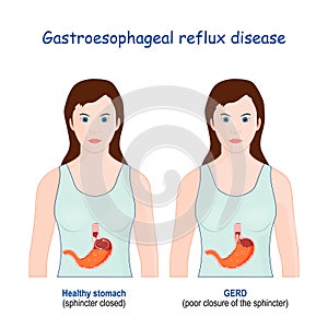 Heartburn gastric and Gastroesophageal Reflux Disease