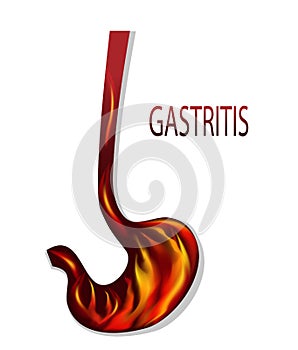 Heartburn, gastritis