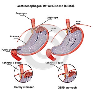 Heartburn and Gastroesophageal Reflux. Disease (GERD). Acid reflux. photo