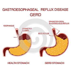 Heartburn and Gastroesophageal Reflux Disease GERD.Concept health