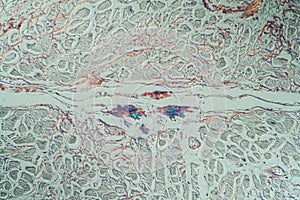 hearth with amyloid deposits of sick tissue