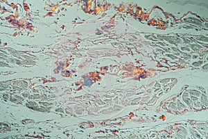 hearth with amyloid deposits of sick tissue