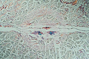 hearth with amyloid deposits of sick tissue photo