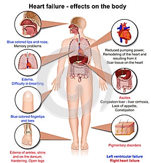 Hearth failure effects of the body 3d medical vector illustration on white background, infographic