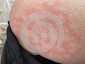 Heat rash hives allergy reaction knee close-up reference picture of blotchy mottled red skin erythema ab igne also known as EAI photo