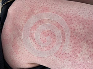 Heat rash hives allergy reaction knee close-up reference picture of blotchy mottled red skin erythema ab igne also known as EAI