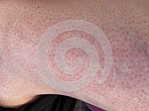 Heat rash hives allergy reaction knee close-up reference picture of blotchy mottled red skin erythema ab igne also known as EAI photo