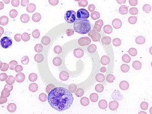 Heat stroke, peripheral blood.