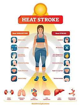 Heat stroke vector illustration. Exhaustion symptoms labeled medical list.