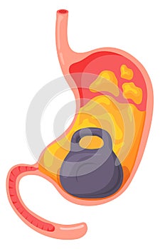 Heavy stomach syndrome. Cartoon medical problem illustration