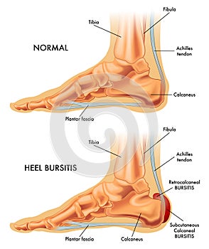 Heel bursitis illustration