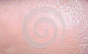 The heel that is full of thick cutin layer