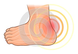 Heel pain