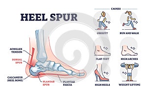 Heel spur or calcaneal bone condition causing pain in feet outline diagram photo