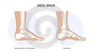 Heel spur poster photo