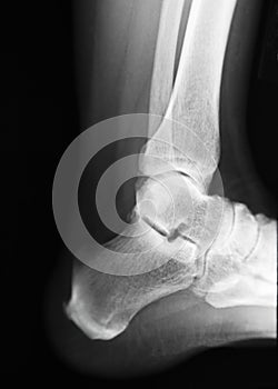 Heel Xray photo