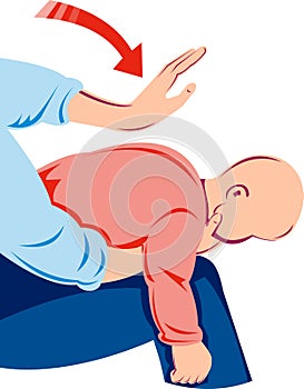 Heimlich maneuver on infant