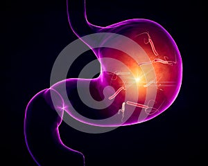 Helicobacter pylori is a gram-negative, flagellated, helical bacterium. Stomach