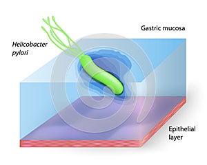 Helicobacter pylori photo