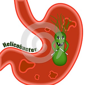 Helicobacter pylori. Ulcers.