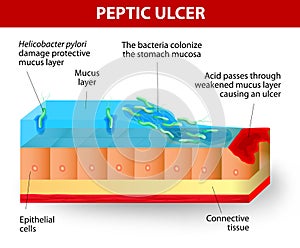 Helicobacter pylori and ulcers disease photo