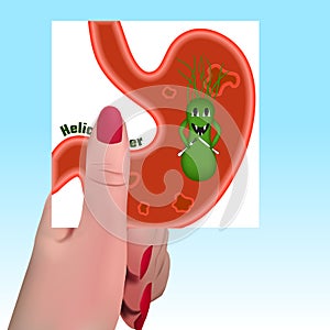 Helicobacter pylori. Ulcers. photo