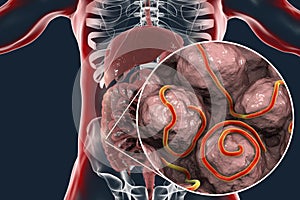 Helminths nematodes Enterobius in the gut