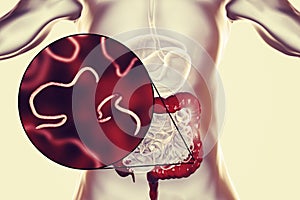 Helminths nematodes Enterobius in the gut