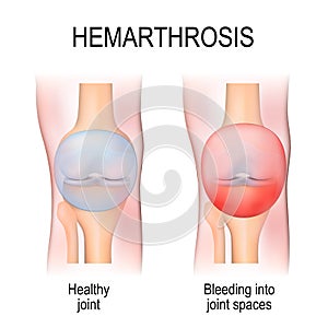 Hemarthrosis is a bleeding into joint spaces