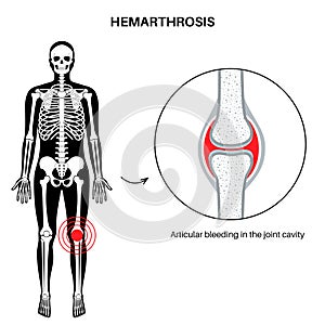 Hemarthrosis in the synovial joint photo